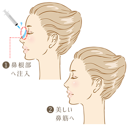 鼻専用ヒアルロン酸注射法