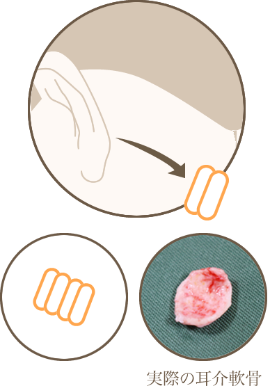 鼻尖縮小・耳介軟骨移植クローズ法
