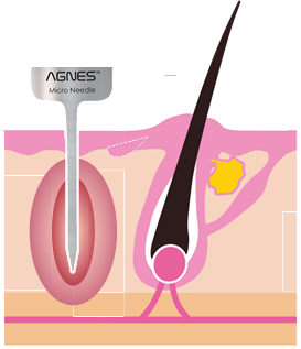 アグネスでの汗管腫の治療