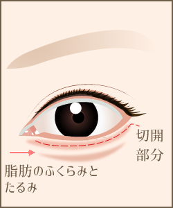 下まぶたのたるみ取り手術