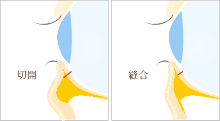 経血膜脱脂フラット法