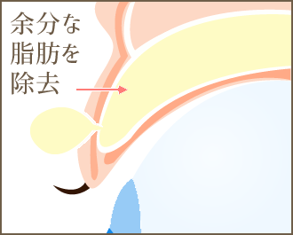 余分な脂肪を除去