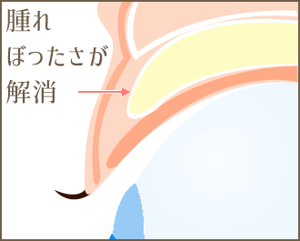 腫れぼったさが解消