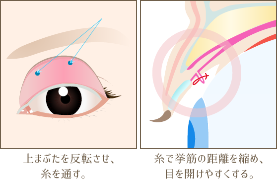 眼瞼下垂ワンデー埋没法