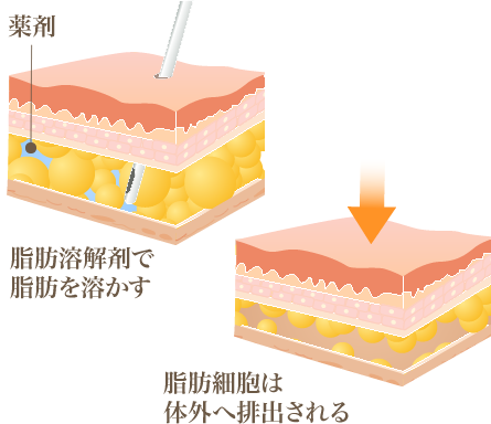 脂肪を溶解し排出する、注射による痩身治療