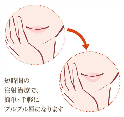 ふっくら唇・あひる口形成注射