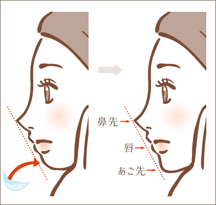 あごプロテーゼ挿入法