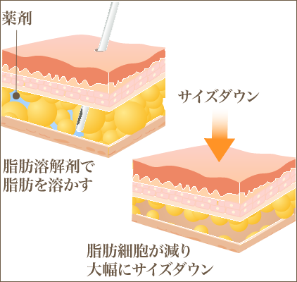 BNLS脂肪溶解注射