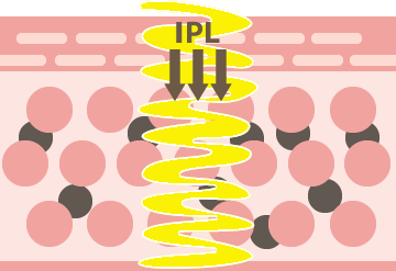 IPLを照射