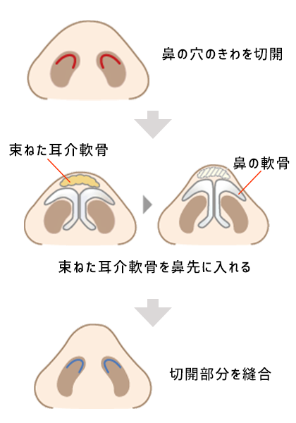 自分の耳の軟骨で、丸い鼻先をシャープにとがらせる