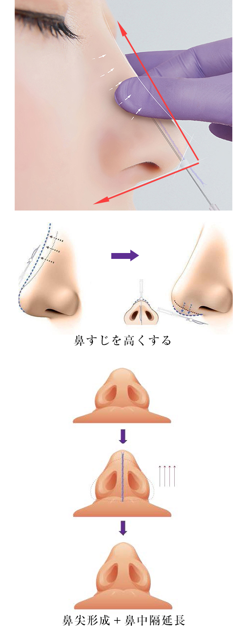 切らない糸の鼻整形・ノーズテスリフト