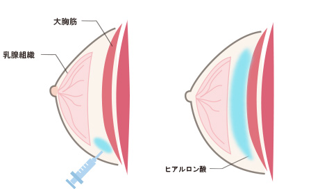 ヒアルロン酸豊胸注入イメージ