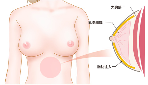 脂肪細胞注入　施術イメージ