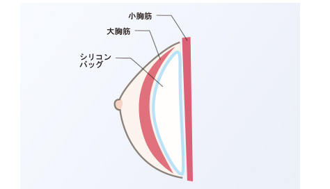 大胸筋下法