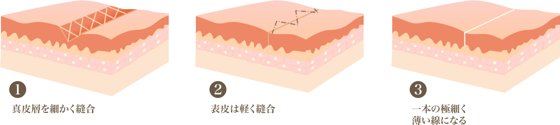 治療あとを目立ちにくくするため