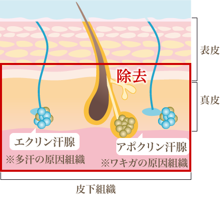 切開剪除(せんじょ)法