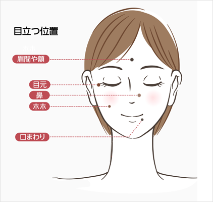 シミ・イボが目立つ位置