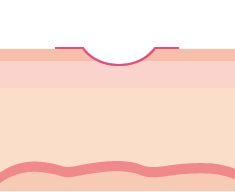 皮膚が盛り上がり、色もなじむ