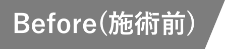 Before(施術前)