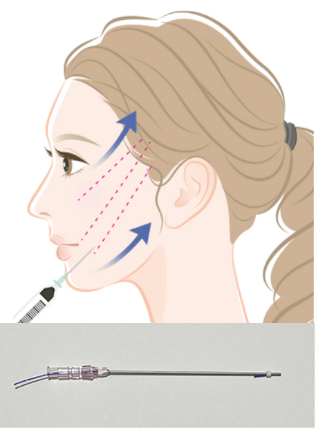 TESSリフト施術イメージ