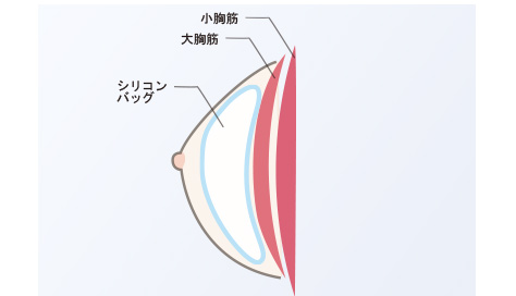 乳腺下法