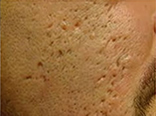 ニキビあとの凹凸、クレーター、毛穴、肌の衰えの症例