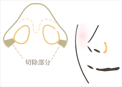 鼻縮小(ダンゴ鼻形成)
