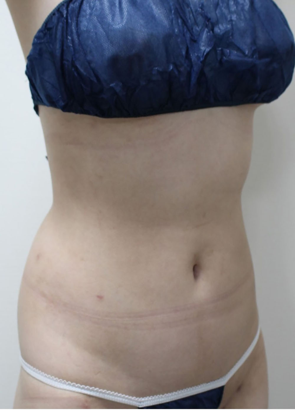 脂肪吸引:腹部の症例