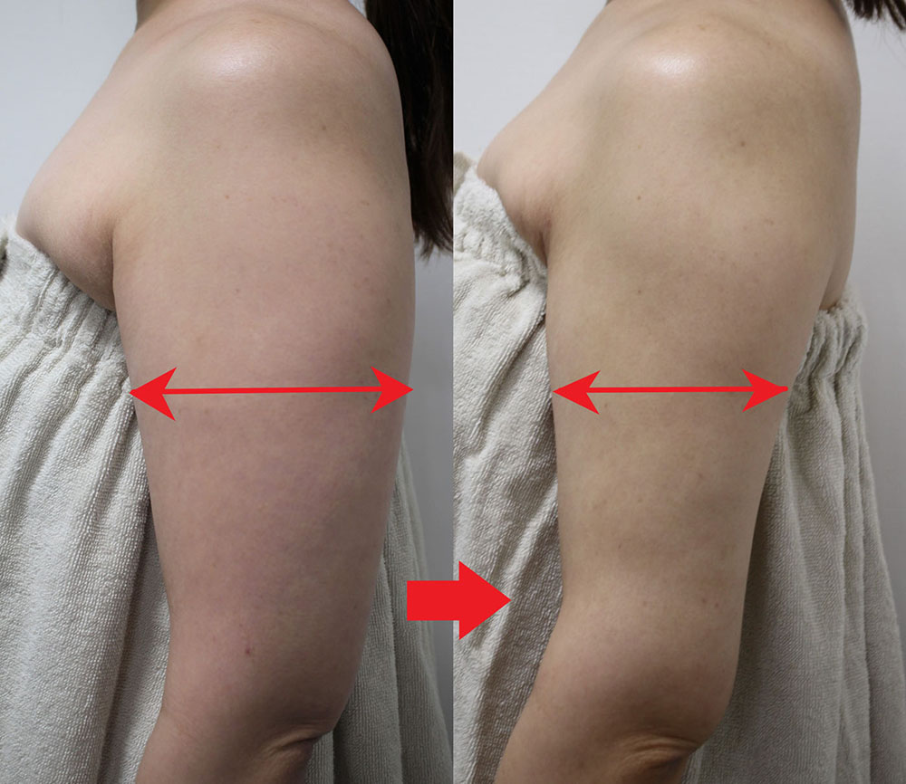 脂肪吸引二の腕左側治療前と3ヵ月後