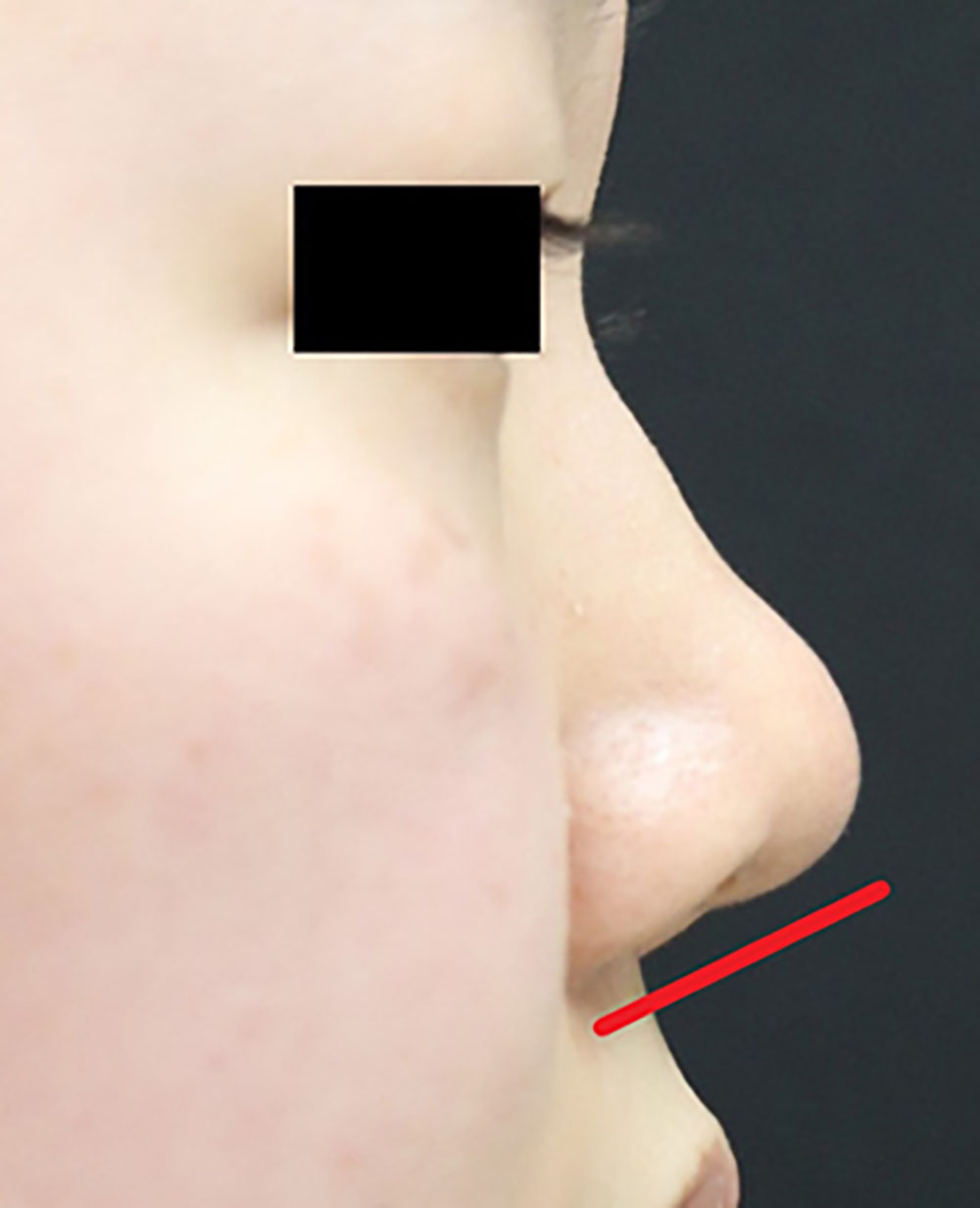 鼻整形の症例