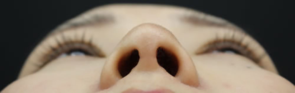 鼻整形の症例