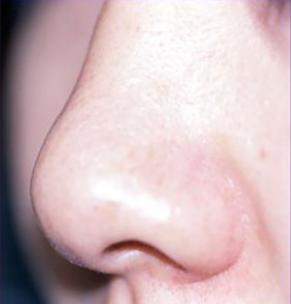 アグネスを利用した鼻の毛穴治療