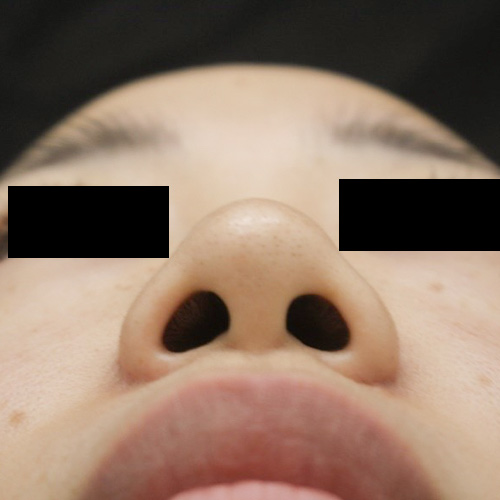 小鼻縮小 外側切除の症例