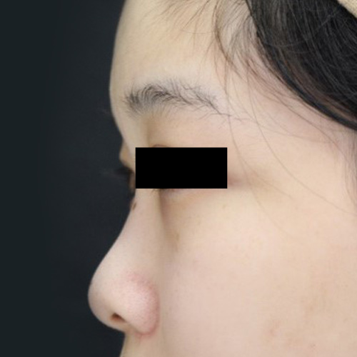 鼻オーダープロテーゼ＋鼻尖耳軟骨移植クローズ法の症例