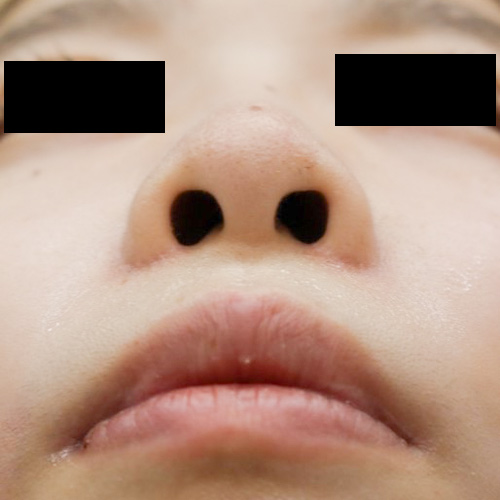 鼻オーダープロテーゼ＋鼻尖耳軟骨移植クローズ法の症例