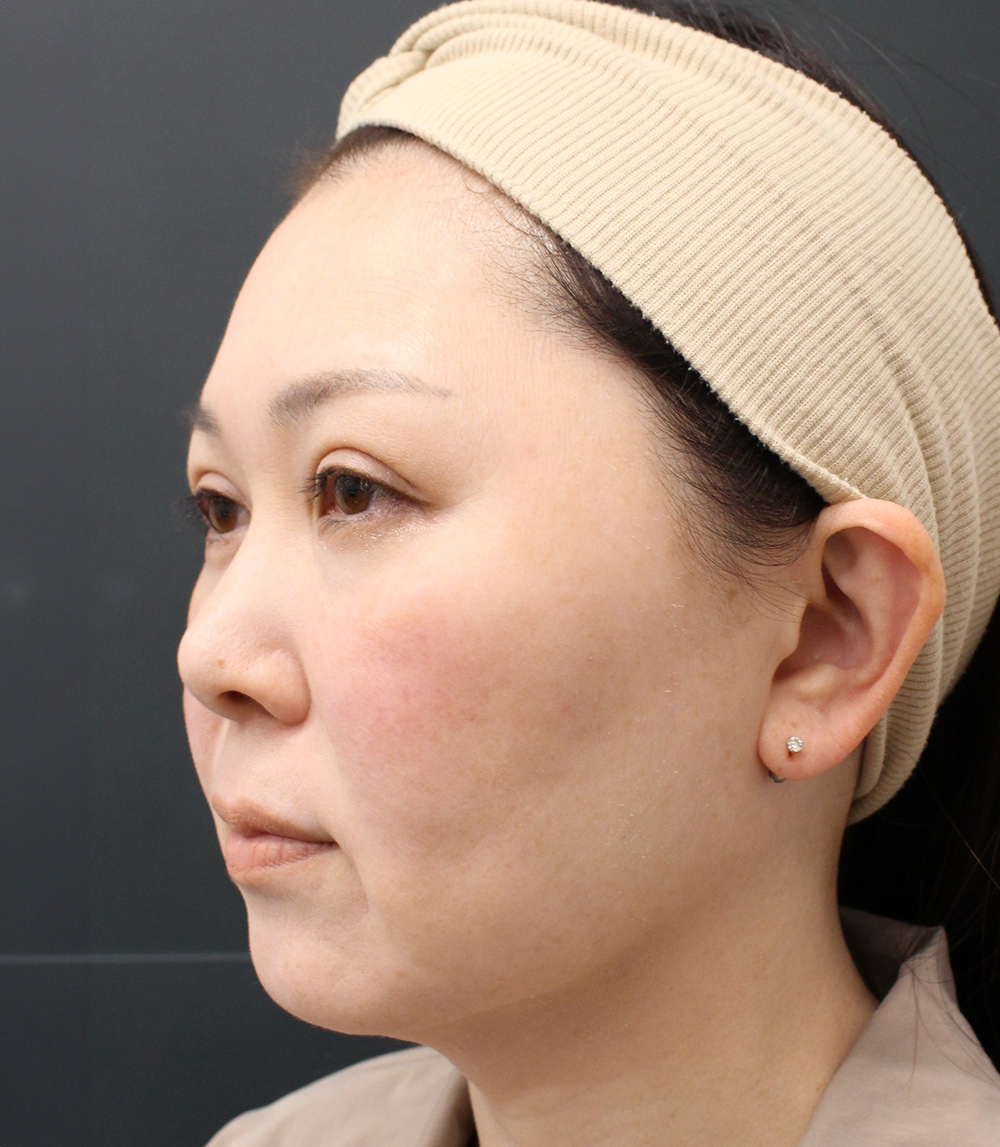 ネオパーフェクトリフト＋頬の脂肪吸引
の症例