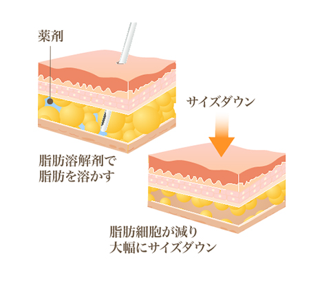 BNLS脂肪溶解注射