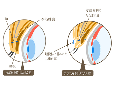 ワンデークイック埋没法 / 切らない埋没法