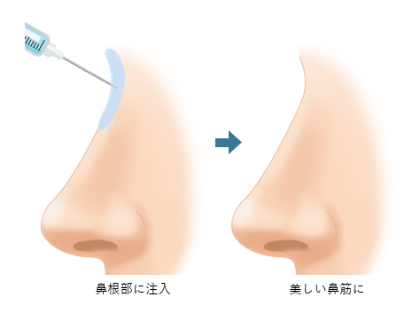 鼻専用ヒアルロン酸注射