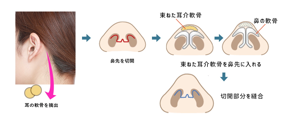 鼻尖縮小・耳介軟骨移植クローズ法