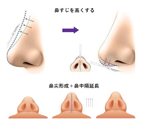 ノーズテスリフト（鼻尖形成＋鼻中隔延長）