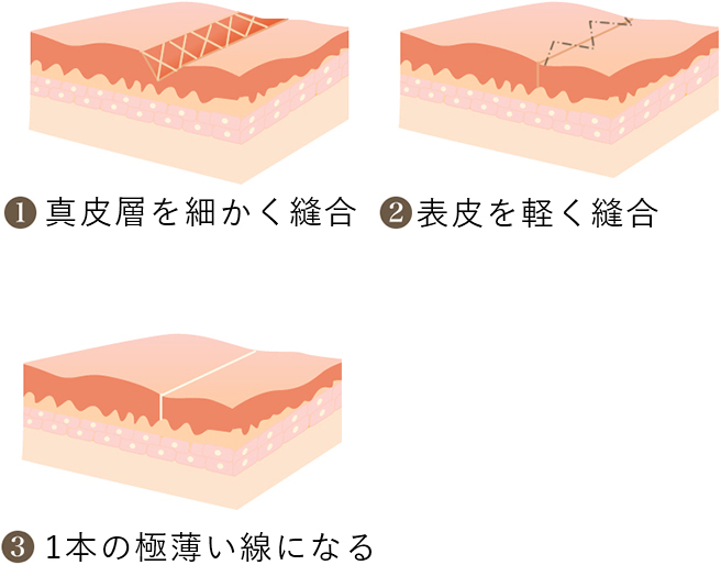 ①真皮層を細かく縫合②表皮は軽く縫合③一本の極細く薄い線になる