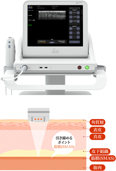 HIFU（ハイフ）とは？