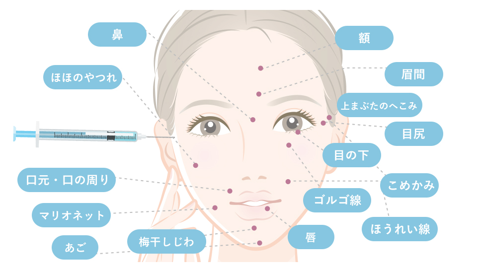 しわを改善させるヒアルロン酸注射