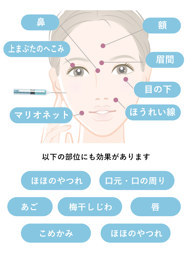 しわを改善させるヒアルロン酸注射