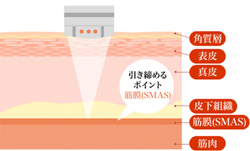 ウルセラの仕組み