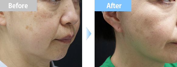 フェイスリフトBA