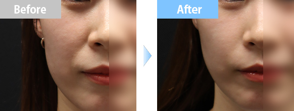 ヒアルロン酸リフトBA