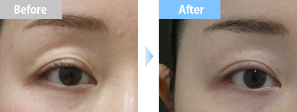 上眼瞼陥凹修正術BA