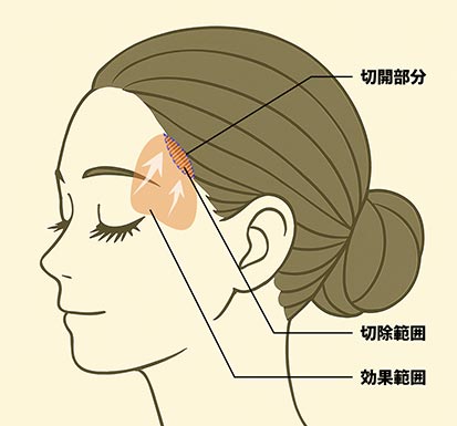 こめかみリフトのイメージ